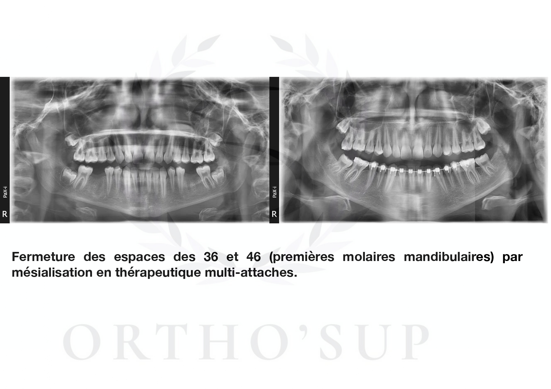 Chirurgien Dentiste Pourquoi Opter Pour La Sp Cialisation En Orthodontie Orthosup