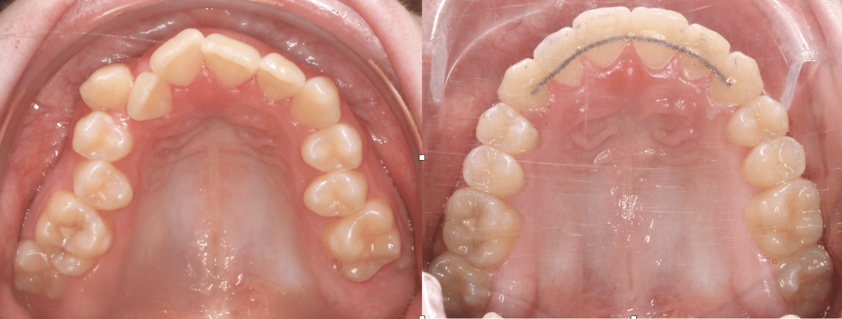 Apprendre à traiter, en orthodontie, les maxillaires fortement insuffisants, porteurs de DDM et malpositions multiples.