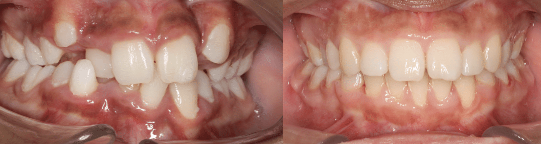 Gestion d’un déficit d’espace critique en orthodontie multi-attaches